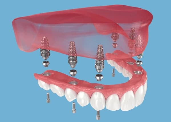 Visualización 3D de la colocación de implantes dentales con cirugía guiada
