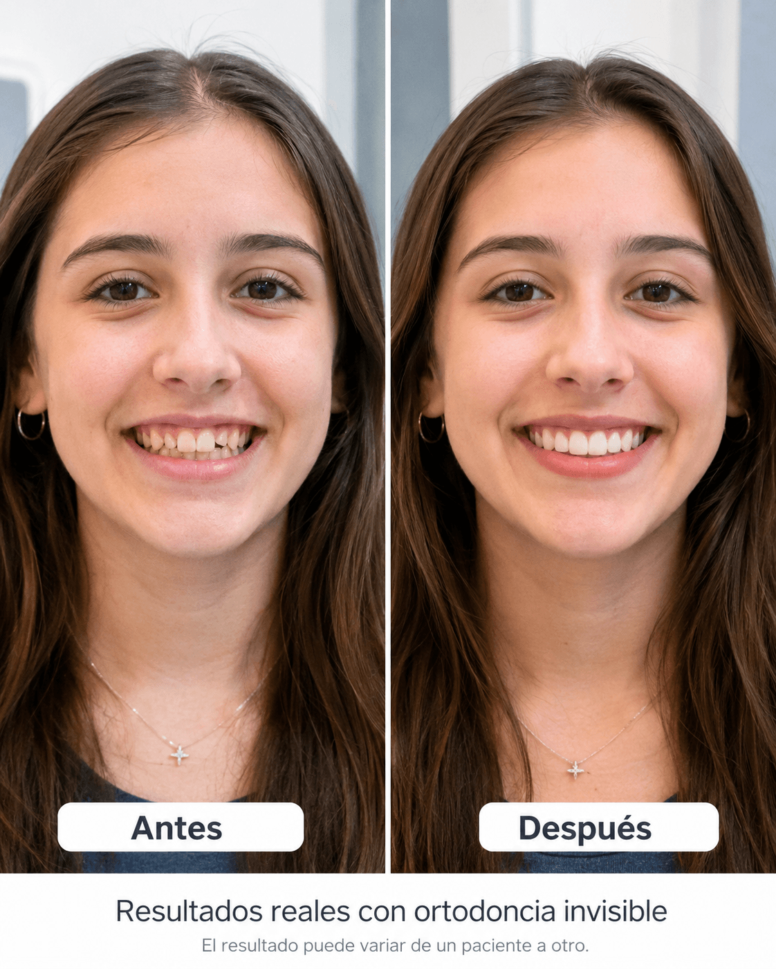 Caso real de ortodoncia invisible en mujer joven - antes y después